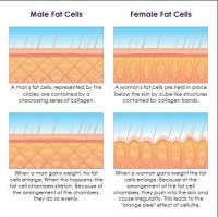 Уважаемая женщина, "целлюлит" у Софи Лорен на фото это обычная жировая прослойка. Женщинам, особенно в период пубертата необходимо иметь достаточное количество жира для того, что бы вырабатывался эстроген и девушка могла превратиться в женщину. Неровной жировая прослойка выглядит потому что жировые клетки у женщин выглядят иначе чем у мужчин, имеют округлую форму и не плотно прилегают друг к другу. Собственно, поэтому даже небольшое количество жира придает коже слегка волнистую текстуру. Очень жаль, что женщина не знает собственную анатомию, не понимает для чего представительницам ее пола нужен жир и не может отличить обычную жировую прослойку от патологии.