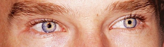 "У Кэмбербэтча глаза, как у Дэвида Боуи. И у Камбербэтча, и у Боуи диагностировано состояние под названием "гетерохромия", при котором радужные оболочки правого и левого глаз имеют разную окраску."

Нифига подобного! У Дэвида Боуи было совсем другое заболевание.
"В 15-летнем возрасте между Боуи и его другом Джорджем Андервудом произошла драка из-за девушки: Андервуд, носивший перстень на пальце, ударил Боуи в левый глаз, из-за чего последнему пришлось оставить школу на четыре месяца, чтобы врачи, опасавшиеся, что он потеряет зрение, смогли провести ряд операций и предотвратить слепоту. Врачам не удалось полностью восстановить зрение, в результате травмы у Боуи возникло дефектное восприятие глубины поля зрения. Боуи заявил, что, хотя он и может видеть своим травмированным глазом, восприятие цвета утрачено (постоянно присутствует коричневый фон). Зрачок травмированного глаза стал мидриатичным, что создало впечатление различного цвета глаз у Дэвида."   
2Гетерохромия — различный цвет радужной оболочки правого и левого глаза или неодинаковая окраска различных участков радужной оболочки одного глаза." Такие глаза у многих людей.