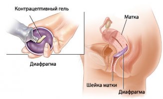 Оказывается, я купила лучший контрацептив на свете