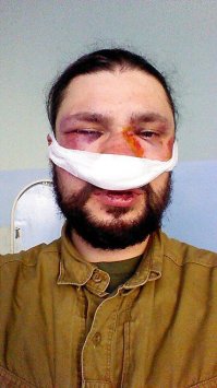 Новый способ удаления нежелательных волос в носу