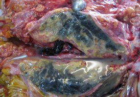 не все знают, что такое панкреонекроз и почему он так страшен.
покажу наглядно.
то, что желтое-это надо удалять. но этим поражен весь орган, а без поджелудочной человек не может жить. 
фото на вскрытии.
вот как то так. так что медом, луком и соленой водичкой не обойтись.