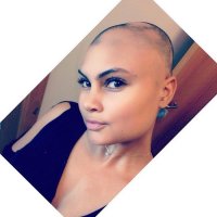 Скорее всего это последствие Трихотилломании — вырывание волосяного покрова на голове или других частях собственного тела. Встречается на фоне стресса или у лиц с неуравновешенной психикой. Среди взрослого населения в два раза чаще встречается у женщин.