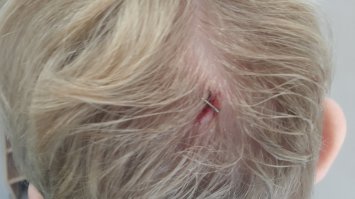 Мой себе вообще на днях башку пробил, пртшлось за степлером идти .
Нерным прошу не смотреть.
Синей изоленты не было (