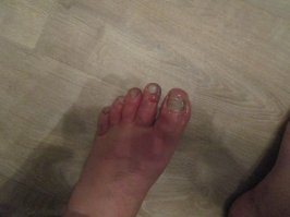 :) Смотрите.   Без всяких бредней,  про неестественный цвет лиц (одна родственница сказала и все потащили), без секретного радиоактивного свитера ( фонила одежда у троих!!!  лежащих в ручье), но Ракитину для своего художественного рассказа нужно было часть доказательств случайно упустить.    И без прочей конспирологии.   

Что мы имеем: 

1.  НА склоне, где находились Дятловцы из факторов у нас есть только:
Снег, 
мороз,
сильный ветер,
ночь, 
камни.   

Что из вышеперечисленного могло заставить их  разрезать палатку изнутри и не забрать лежащие там вещи ?? :)  По моему только одно - снег. (ну и вторично ночь, мороз и ветер).    

Палатка у них была поставлена неправильно и очень неустойчиво.  Почему? :) Покажу.  
Эта гамнопалатка была сшита из двух,  и чтобы ее нормально установить - всегда колхозилась дополнительная конструкция растяжек по центру палатки.  (на фото ниже).    Только при таком расположении кстати они могли разжечь печку,  потому-что она крепилась на проходящий внутри через всю палатку трос.   Они печку и дрова с собой взяли, но когда на склоне пришлось ночевать, внезапно выяснилось, что греться нечем.   

2.  ТАм весь склон, как коленка у младенца,  постоянный ветер сдувает весь снег в ложбину и заполняет все углубления и скапливается около всех камней-препятствий.   Дятловцы зафигачили палатку прямо на пути миграции снежной поземки.   Конечно ее тут-же начало засыпать (какой там снегопад видно на фото установки палатки).  
Не нужно никаких снежных досок и лавин - достаточно полкуба снега насыпать на провисающий бок палатки,  чтобы она обвалилась (она держалась на лыжных палках, которые были почти не воткнуты в снег, под палаткой почти сразу были камни, это из воспоминаний, в допросах есть).   Возможно она изначально начала провисать, но все сидели и пытались согреться игнорировав этот факт,  не суть.  

Половина участников без обуви.  Ммммммм.  Я вам личное фото ноги покажу, через 30!! минут откапывания провалившегося кроссовка в одном носке.  Это было неделю назад. На улице было -15 и без ветра.  А там был дубак, ветрина и снег (понижение температуры до -25 это тож. факт от метеостанций).    

Соответственно, у всех полуодетых были обморожены руки и ноги уже через час, после спуска к кедру (они и замерзли первыми,  и оставшиеся и пытающиеся вернуться к палатке),  вообще никакого криминала не вижу.