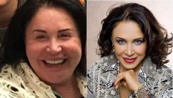  Знаменитости, которым пластические операции пошли на пользу