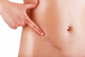 А почему рубец от пупка или аппендикс уже по другому вырезают?