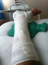 пол года лишения штраф 5000р. и сломать ногу!