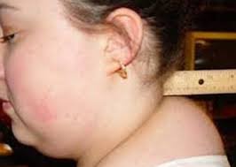 Крупные лицевые сосуды и нервы залегают совсем не в коже, а гораздо глубже, а уж жировой ткани у некоторых...