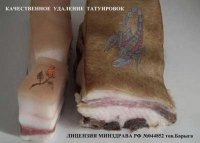 Самостоятельная попытка удалить татуировку изуродовала студентку