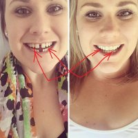 отличные вставные зубы...и брекеты тут не при делах
