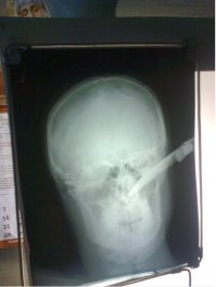 Случай из практики моей жены.