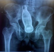 Как говорил Карлсон, - Дело житейское. Бывает и хуже