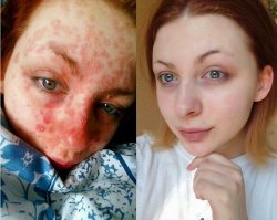 какой то бред сочинили. тут же есть фото,где она без грима и без псориаза. когда у неё такие высыпания, она и не сможет их закрасить! под тоналкой это всё будет видно! вот на этом фото она показала себя в момент обострения и в момент ремиссии. она на обеих фотках БЕЗ косметики.