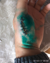 блин, я себе так палец порезал болгаркой, когда с пружиной колхозил, на пару сантиметров в глубь. потом пять швов накладывал, чтоб быстрее зарубцевалось.