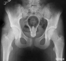 В миллиметре от позора)