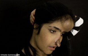 Ее отцу с помощью благотворительной организации удалось вывезти ее из страны. В США медики 10 недель пытались спасти лицо девушки.Доктора поместили надувную силиконовую раковину под кожу девушки на лбу и постепенно наполняли ее жидкостью, чтобы расширить кожу и получить дополнительные ткани для их дальнейшей пересадки. Им также пришлось взять ткань с ее руки и пересадить ее на лицо.