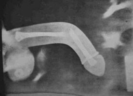 С дуру можно и  XY@ сломать(русская поговорка)
С дуру вряд ли, а вот с дурой.... можно:)))))))