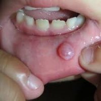 "Воспаление малых слюнных желез" выглядит совсем по-другому: