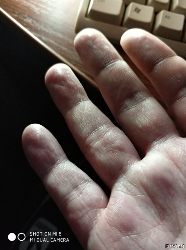 А мне кстати два сухожилия сшили на пальцах. Пальцы теперь работают. Правда очень долго восстанавливать после операции надо было.  Вот такие шрамы остались от операции.