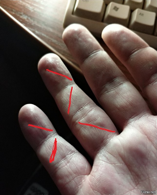 А мне кстати два сухожилия сшили на пальцах. Пальцы теперь работают. Правда очень долго восстанавливать после операции надо было.  Вот такие шрамы остались от операции.