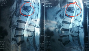 Моя мама тоже сломала,  в прошлом году позвоночник. 
Ей 78 лет. 
Живёт одна. Ходит в карсете.  Сама всё по дому делает. 
Выздоравливай мама.