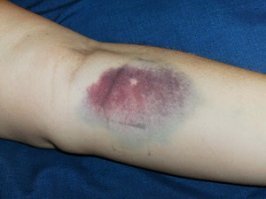 Такая красючка мне в больничке все руки иголками попротыкала к х-ям. Приходит сиськами машет, волосы поправляет, вздыхает томно, духами пахнет, ну хоть бери и иби ее прям там. НО... в вену не могла попасть курва жебана минут по 20. 
Синяки были с пачку сигарет  
Я пару дней ее капельницы пережил, потом начал матом орать, чтобы не подходила ко мне.
Пришла старшая медсестра, спрашивает, чо орешь ? 
Я говорю, смотри нахой!  На двух руках живого места нет. 
Она поглядела, как на ту красивую гаркнет. -Машка, ну ёбтвоюмать!!  Потом в коридоре орали еще. Та хоть красючка, но во рту говно хуже шмары с вокзала.  пациенты еще голос подали еще, там походу не я один пострадал от ее руки. 
 Еще рассказывали там как одна такая же красивая вместо внутривенного укола сделала укол в задницу бабке. В итоге бабке пол жопы пришлось отрезать. хз может и байка
в общем красота не показатель ничихуахуа