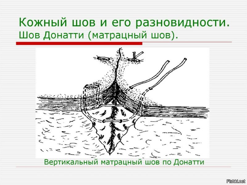 Прежде чем бегать иски подавать может парнишке стоило просто загуглить "виды хирургических швов"? У него шов прям как по учебнику. Этот вид хирургического шва называется шов Донати. "Вертикальный петлеобразный шов Донати при пластических one - рациях имеет ряд преимуществ. Этот шов обеспечивает полный контакт одной раневой поверхнос ти с другой, точное сопоставление краев раны, отсутствует сдавление кожных сосудов, свойственное обычному петлеобразному шву. Шов Донати обеспечивает хоро ший косметический результат."