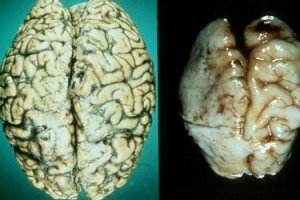 Калории хренории... Какая нахрен разница.
Сколько тысяч/миллионов нейронов погибает от стакана водки? Рюмки вина? Кружки пива?
Картинка называется - угадай где мозг человека употреблявшего алкоголь?