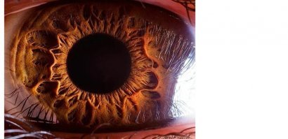 Дистрофия радужной оболочки. Опасная штука...
