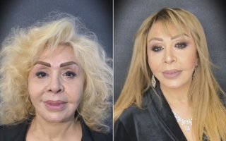 Ну тут,мне кажется,не в коже проблемы.Пить меньше надо.