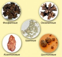 У любителя тофу врачи удалили 420 камней из почек