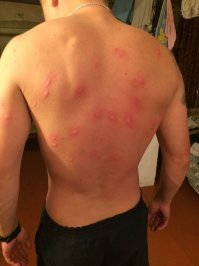 Мне комары тоже делали тест на аллергию)