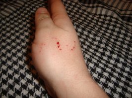 не чего страшного .  и болезненного.