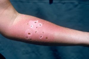 Больше всего меня тут удивило, что автор не Джонни, ну да ладно, через месяц его супруга тоже побывала в Австралии и обнаружила у себя на руке еще более загадочные пятна, о боже подумала она! Это точно новичок, никакой это не еж! Все сми пестрели заголовками русские прибегают к более изошренным методам Но доктор сказал, что ее укусила медуза, она успокоилась. Всё конец истории.