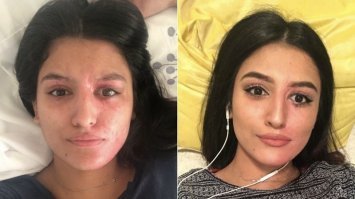 "после операции она стала выглядеть ещё красивее" - А разве это фотки до операции? Вроде фото после операции, но до косметики... Шрам небольшой около левого глаза остался.  Или шрам был ещё до кислоты?