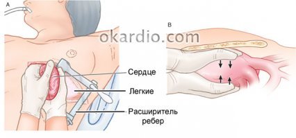 А вы в курсе что прямой массаж это когда грудная клетка вскрывается и сердце напрямую массируется.
На видео непрямой массаж сердца.