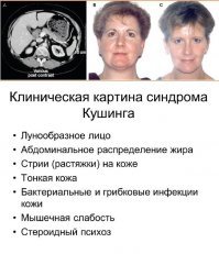 медицинские реальные причины ожирения . Самые распространенные. Поликистоз - 10% женщин, от 15 до 40% населения России страдают от тироидных патологий, при этом в отдельных регионах процент пациентов, приближается к 95%, синдром Кушинга как болезнь довольно редкая, но как сам синдром он 100% встречается у пациентов с аутоимунными заболеваниями , которые принимают гормональную терапию, а это по статистике минимум 30% людей в нашем Евроазиатском регионе. Так что, когда очередной раз будете гнобить очередного жирдяя-жидяйку, подумайте, что вы можете оказаться среди невезучих почти 40% и хотя бы сохранить свой вес , не говоря об ущербе для здоровья, для вас будет архисложно. Это пожизненно есть меньше и тренироваться больше, чем любой обычный, здоровый человек.  К стати, тренера вам в зале говорят, что кардио для похудения не должна длиться свыше 45 минут, потому что после происходит выброс кортизола, а хроническое повторение такого выброса приводит к кушингообразному виду, то есть скорее потолстеете, нежели похудеете.