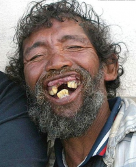 Как рвали зубы в раньше: искусство и стоматология