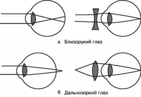 Только вот сделать выпуклую линзу очень просто (работает даже если просто катать кучку грубо обработанных "шариков" в песке).
А вогнутые - нет.

Но при близорукости нужны как раз вогнутые.