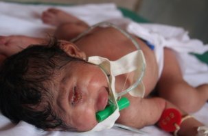 Тяжёлые генетические мутации у поросёнка. У людей, к примеру, есть крайне редкое генетическое отклонение - циклопия (чаще всего это отклонение можно наблюдать в странах Азии).