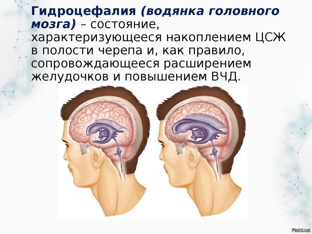 Риногенная гидроцефалия. Гидроцефалия водянка головного мозга. Мультилокулярная гидроцефалия. Гидроцефалия клинические проявления.