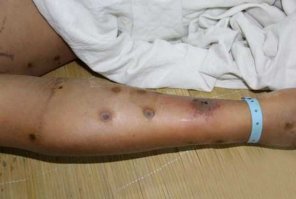 Ну да. Как комарик укусил.