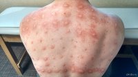 12 печальных раз, которых аллергия застала врасплох и кардинально изменила лица