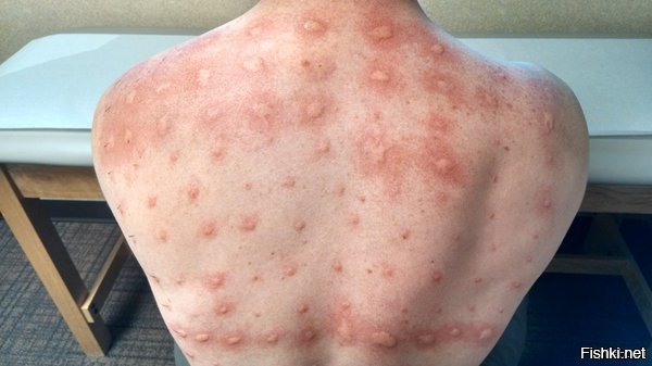 12 печальных раз, которых аллергия застала врасплох и кардинально изменила лица