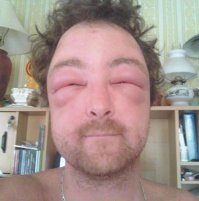 Иванушка, когда тебя аллергия ( отёк ) шибанёт, я очень хочу посмотреть, как ты в аптеку за антиистамином будешь нестись и орать на всю Ивановскую:
- Что за муйня?!