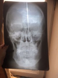 Эт что, тут вот один клоун по дурке решил голову проковырять, чтоб мозги подышали. Что характерно, в мозг не попал за отсутствием...
А вы говорите пингвинов увидел ))