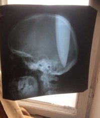 Эт что, тут вот один клоун по дурке решил голову проковырять, чтоб мозги подышали. Что характерно, в мозг не попал за отсутствием...
А вы говорите пингвинов увидел ))