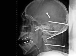 Воспитатели детсада мучили малышей с помощью канцелярских кнопок