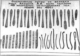 Китаец на спор проглотил ложку и прожил с ней в течение года