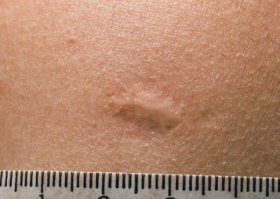 Прививку от оспы намочил?